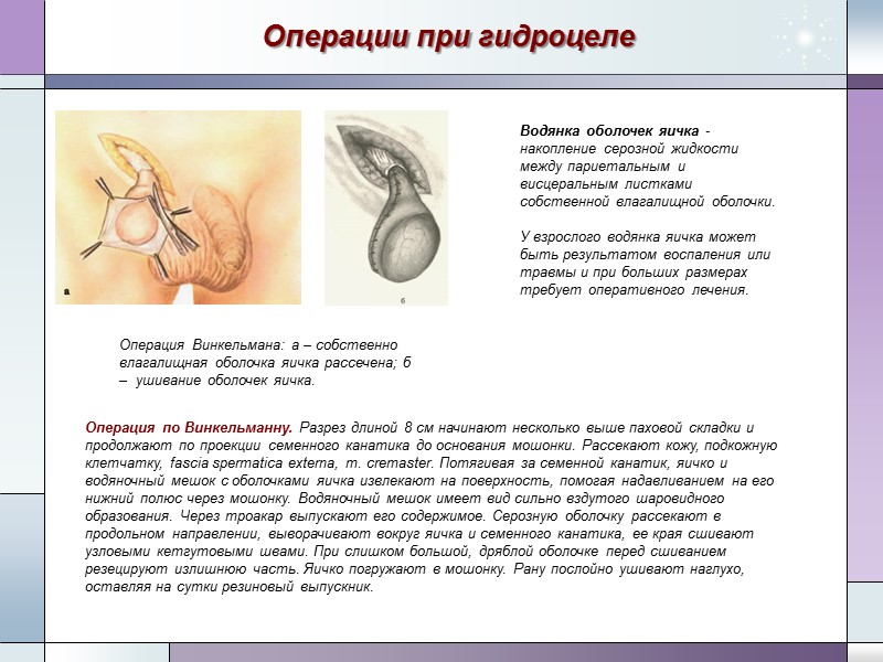 Операции при гидроцеле Операция по Винкельманну. Разрез длиной 8 см начинают несколько выше паховой